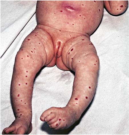 先天性皮肤缺损 - Aplasia Cutis Congenita