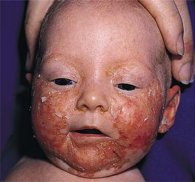 色素性荨麻疹 - Urticaria Pigmentosa